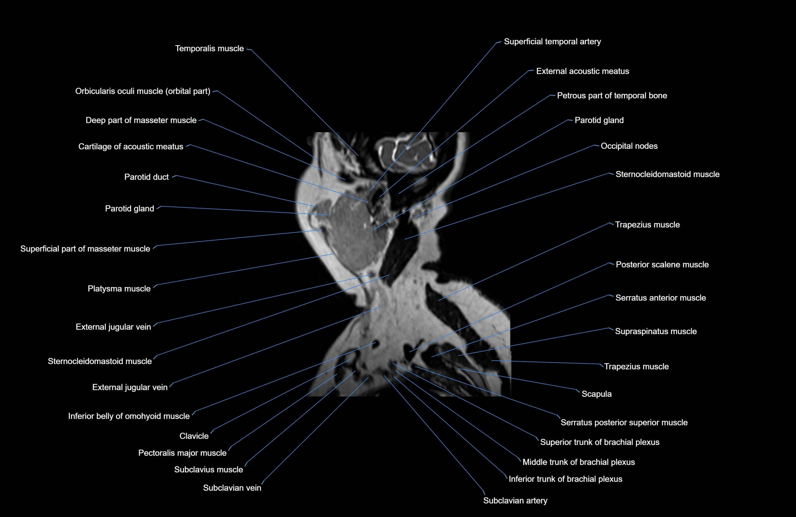 Neck MRI sagittal cross sectional anatomy 3D 1mm 3T radiology  image-img-00001-00037.webp